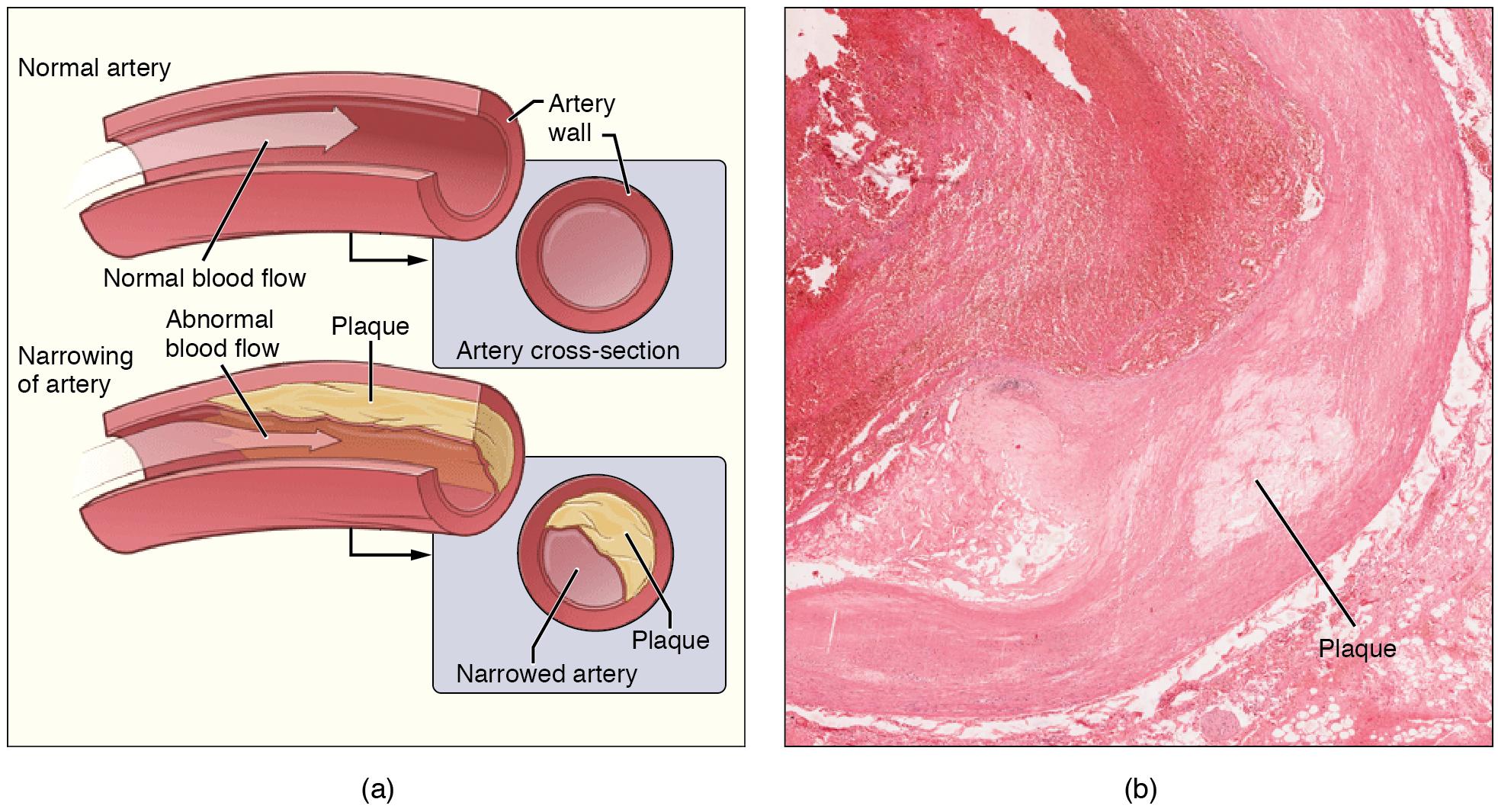 On the left is a cartoon showing a normal artery and one with atherosclerosis, in which a plaque has formed, impeding normal blood flow. On the right, a tissue section viewed under a microscope shows buildup of connective tissue in the artery wall