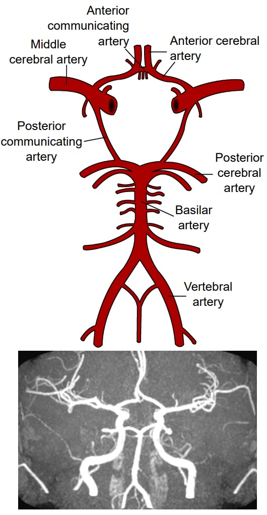 Diagram of the circle of Willis and an angiogram showing the structure in real life.