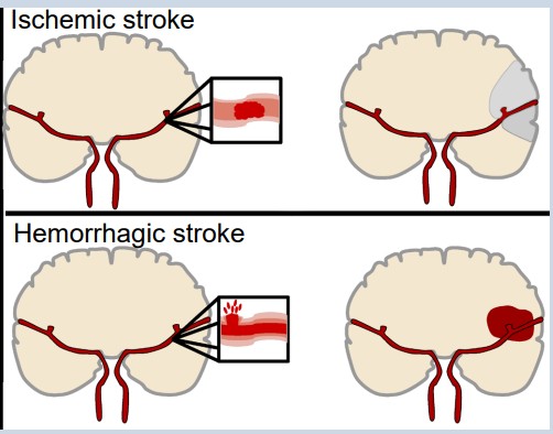 Diagram illustrating the two main types of stroke and the effect on blood flow to the brain
