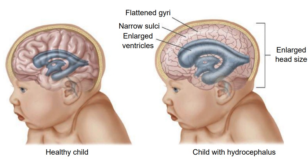 Comparison of a childs brain with and without hydrocephalus