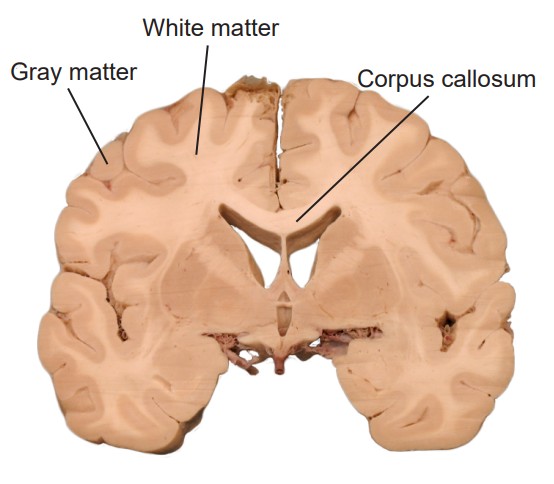 Diagram of brain showing gray matter, white matter, and the corpus callosum