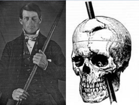Photograph of Phineas Gage and a drawing of his skull with the rod impaled through it
