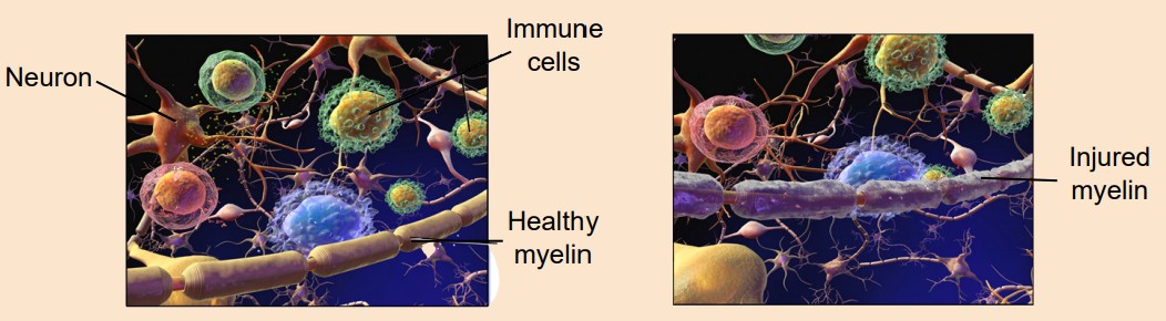 Comparison showing a healthy myelin versus the damaged myelin found in Multiple Sclerosis patients