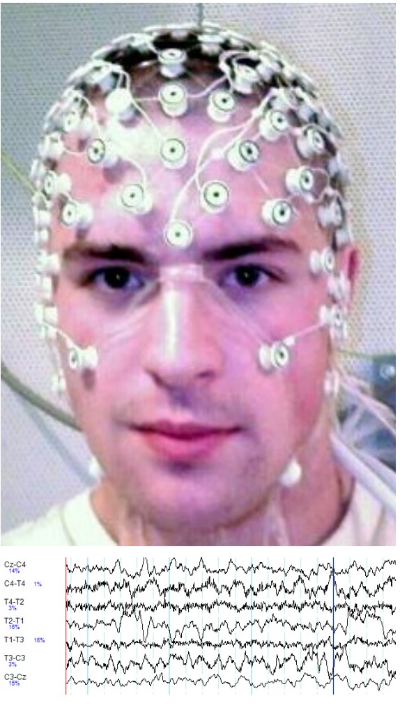A picture of a patient undergoing EEG and the information it produces