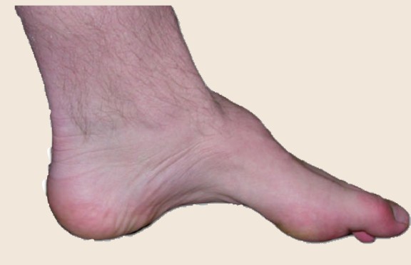 A foot with a higher arc than normal