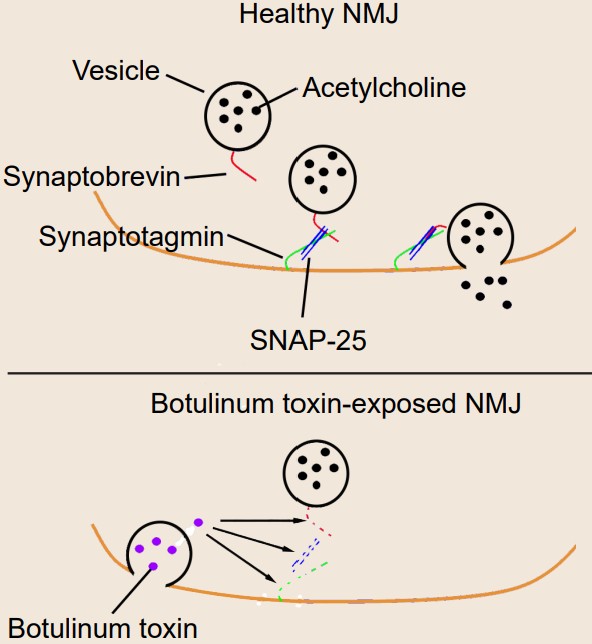 Comparison between healthy NMJ and NMJ that's been exposed to Botulinum toxins