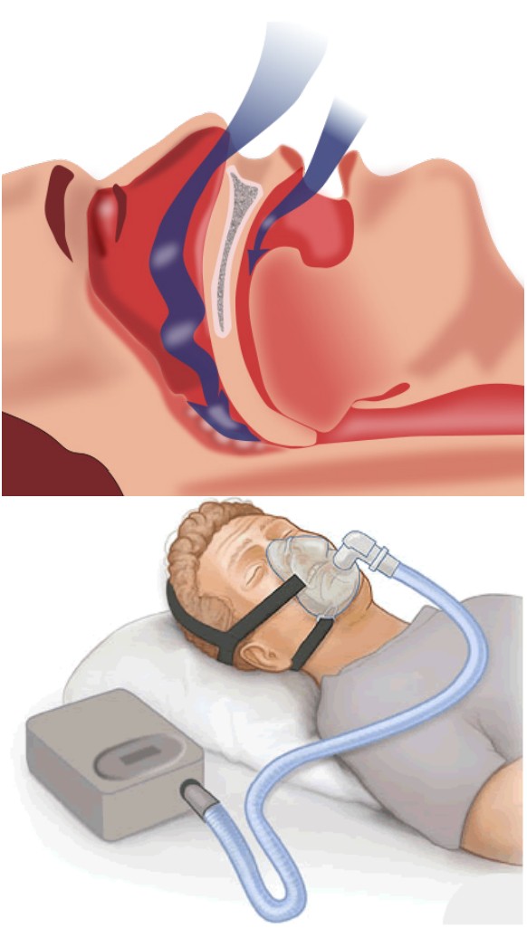 Visualization of airway blocked when someone with sleep apnea sleeps, and the CPAP device people wear while they sleep