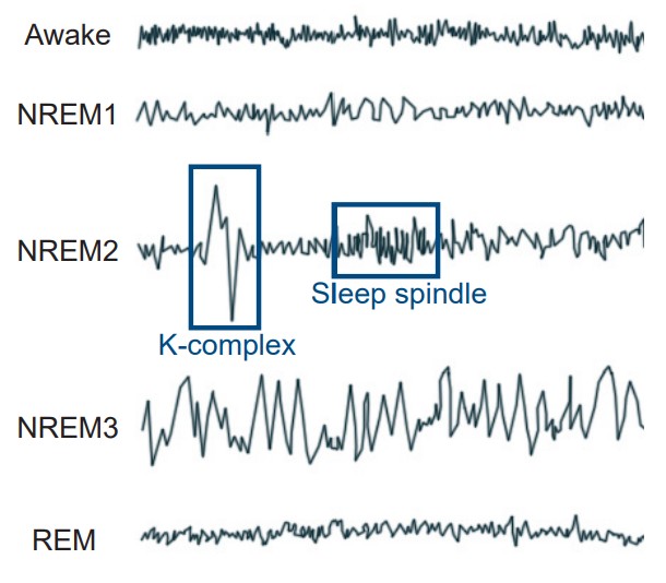 Patterns of brain activity in different stages of sleep as gathered from an EEG