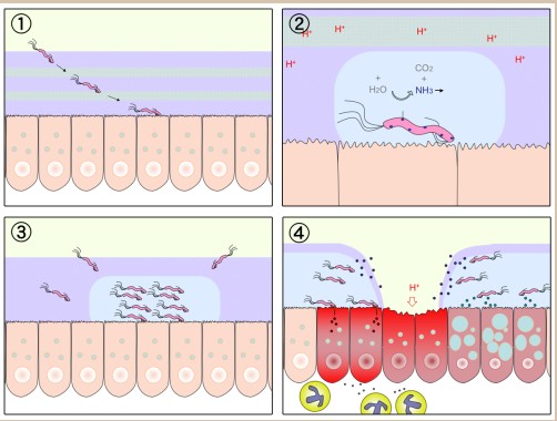 Formation of stomach ulcers through interactions with H. pylori and stress