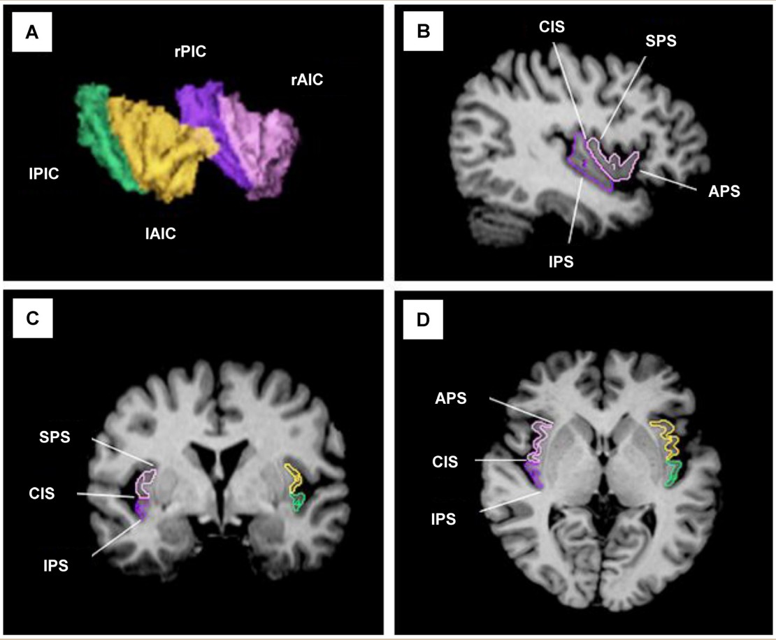 Brain images comparing people with OCD versus neurotypical patients