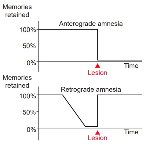 Graphs depicting the differences in memories retained with anterograde and retrograde amnesia