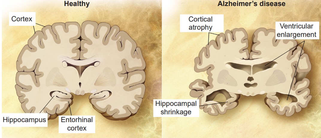 Comparison of a healthy brain versus a brain of a patient with Alzheimer’s disease.