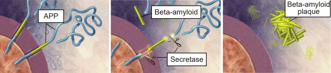 visualization of the formation of beta-amyloid plaques that could lead to Alzheimer's Disease