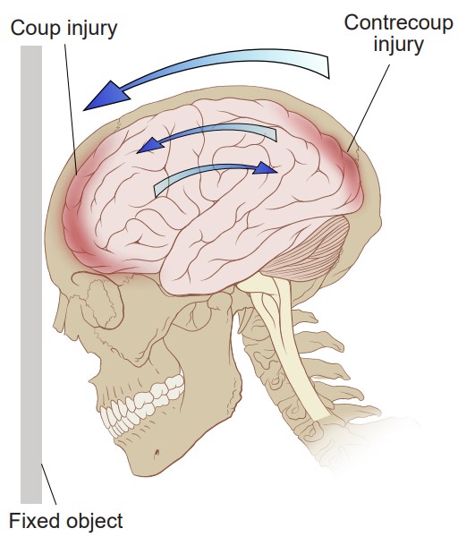 Image showing where coup and contrecoup injuries occur in a TBI